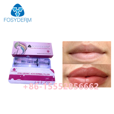 acido ialuronico del riempitore cutaneo di 2ml Fosyderm per il potenziamento delle labbra