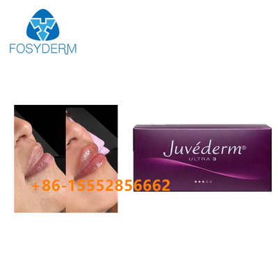 Iniezione acida ialuronica cutanea di Juvederm 2ml del riempitore di potenziamento del labbro