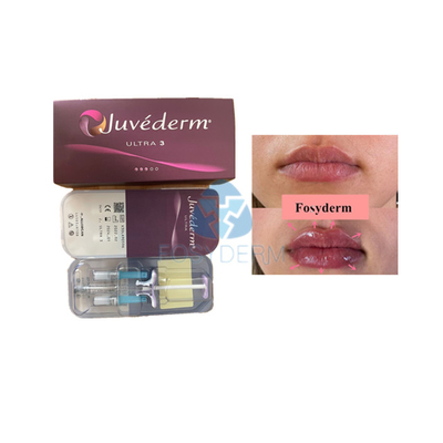 Filler cutaneo per acido ialuronico Voluma Fosyderm per il miglioramento delle labbra