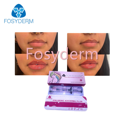 Il riempitore cutaneo acido ialuronico di Fosyderm dell'iniezione per l'incrocio del labbro 2ml si è collegato