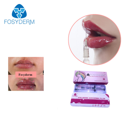 L'incrocio di Fosyderm ha collegato il riempitore cutaneo acido ialuronico per ringiovanimento della pelle