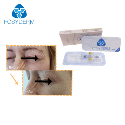 L'incrocio di Fosyderm ha collegato l'acido ialuronico della linea sottile del riempitore 2ml dell'ha per le grinze dell'occhio