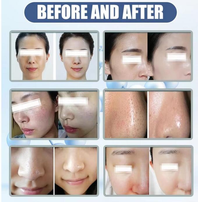 Miglior cura del viso a domicilio Microdermabrasion Machine 2024 attrezzature di bellezza 6