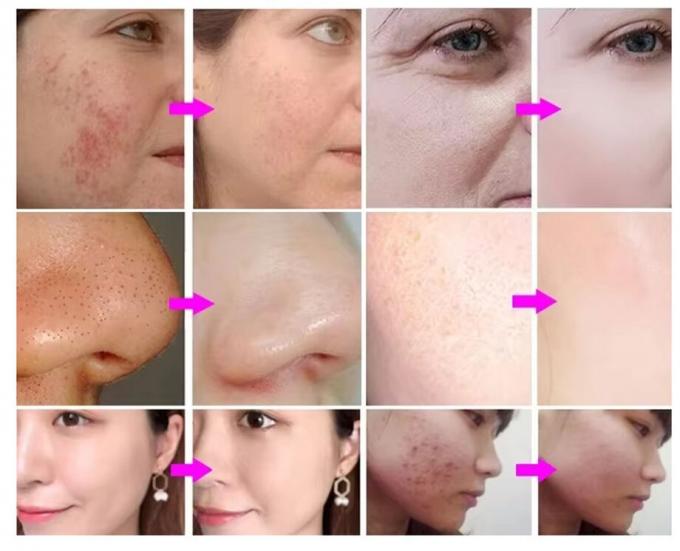 Macchine per la pulizia del viso Macchine per la pulizia del viso Acqua antirughe Oxgen Jetpeel 3