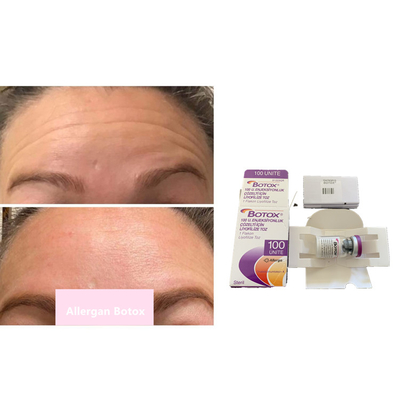 Tipo A della tossina botulinica di Allergan s 100iu per le anti grinze