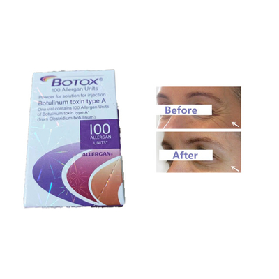 Grinze della fronte delle unità della tossina botulinica 100 dell'iniezione di Allergan Botox