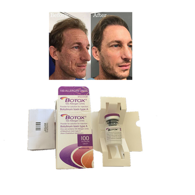 Allergan  100 unità Tipi di iniezione di tossina botulinica antirughe