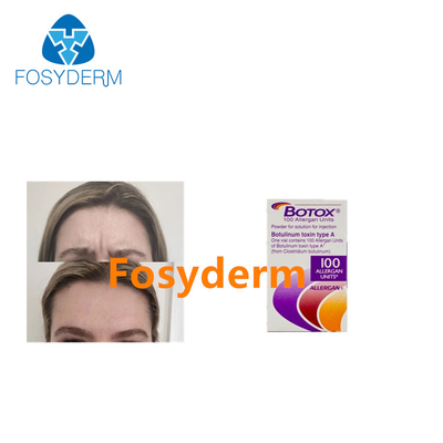 Iniezione della tossina botulinica di Allergan  di 100 unità per le anti grinze