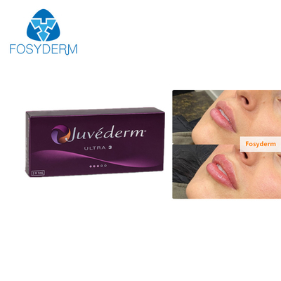 L'incrocio di Juvederm Ultra3 2ml ha collegato l'iniezione acida ialuronica del riempitore cutaneo delle labbra