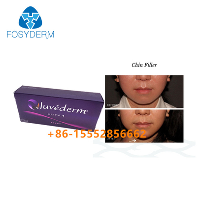 Riempitore Juvederm Ultra4 2ml cutaneo di Chin Augmentation Hyaluronic Acid Facial