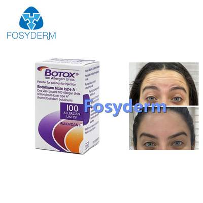 100Units Allergan Toxion botulinico per rimuovono il tipo facciale A di Botox delle grinze