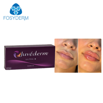 Juvederm Dermal Lip Fillers 2*1ml Acido Ialuronico Iniezione a collegamento croce