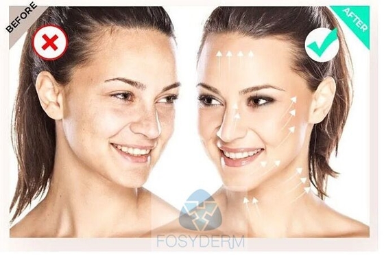 Siero per mesoterapia  135 HA riempito FILORGA 5*3ml rinfresco rinforzante della pelle