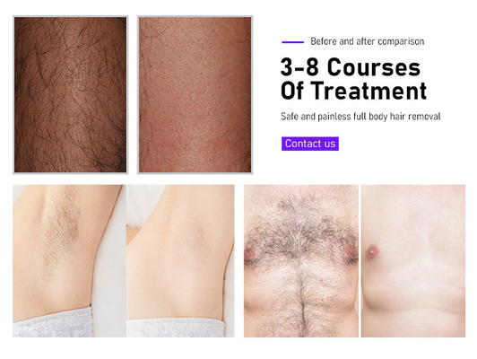 Attrezzature di bellezza Fosyderm Laser depilazione macchina 3 onde 12 barre