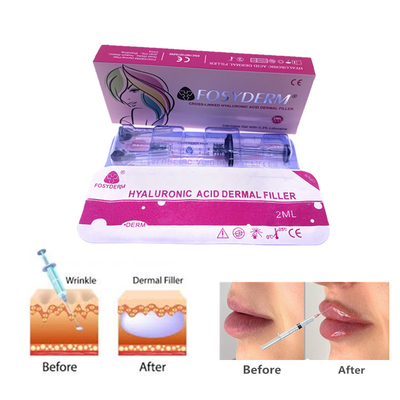 Fosyderm 2ml Gel di Acido Ialuronico Iniezioni Dermiche di Riempimento Per La Cura della Pelle Faciale E Naso