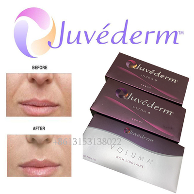 Juvederm Voluma Acido ialuronico per labbra