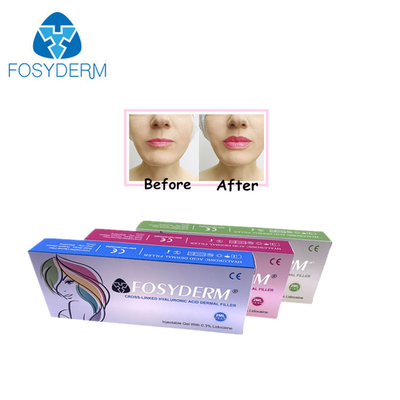 Gel 1 ml di filler con acido ialuronico per la riduzione delle rughe e la modellazione del viso