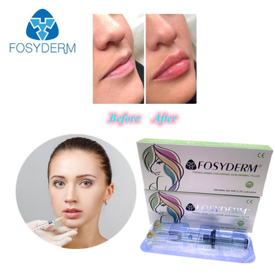 Gel 1 ml di filler con acido ialuronico per la riduzione delle rughe e la modellazione del viso