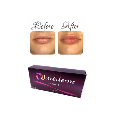Juvederm Acido ialuronico iniettabile Gel di riempimento cutaneo