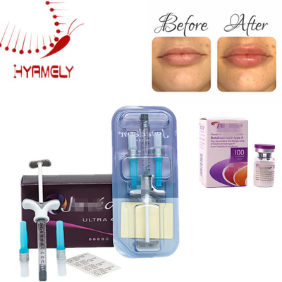 Filler dermico all'acido ialuronico per rughe e aumento del volume delle labbra