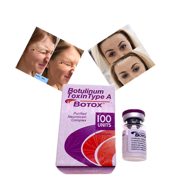 Tipo della tossina botulinica di Allergan un acido ialuronico del riempitore cutaneo dell'unità di  100