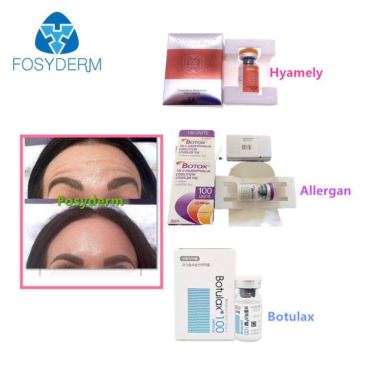 Un tipo di 100 unità iniezione facciale di  Botulax delle grinze di Allergan della tossina botulinica un'anti