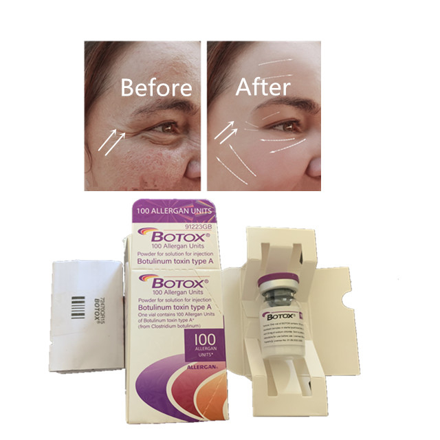 Riduzione delle rughe 100 unità Allergan Botox Iniezione elimina le linee sottili del viso