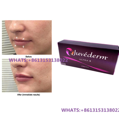 Juvederm Dermal Filler per labbra Juvederm Ultra3 Ultra4 Fillers Siringa preriempita