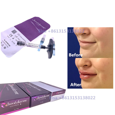 2×1 ml di iniettabile per riempimento cutaneo Juvederm Springa Ultra3 Ultra4 Voluma