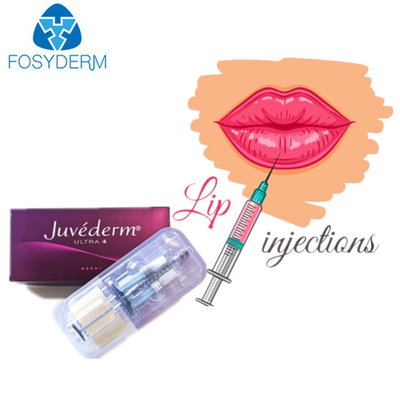 Riempitore cutaneo acido ialuronico ultra 3 di Juvederm per le labbra del fronte