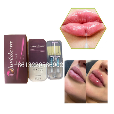 Cutaneo acido ialuronico dell'iniezione 2ml del riempitore del labbro di Ultra3 Juvederm
