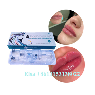 Ce acido ialuronico 1ml antinvecchiamento 2ml 5ml del riempitore del labbro di Juvederm dell'iniezione del gel