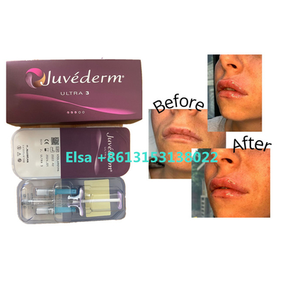 Riempitore cutaneo di Juvederm dei prodotti cosmetici per le labbra del fronte