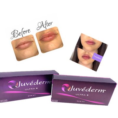 Ce cutaneo acido ialuronico 2ml antinvecchiamento del riempitore del labbro di Juvederm dell'iniezione del gel