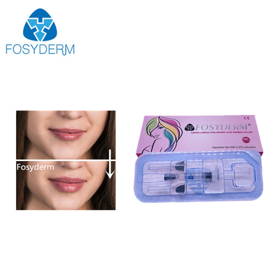 2 ml di caricatore Acido ialuronico caricatore cutaneo per l' ingrandimento del viso, naso e labbra 24 mg/ ml